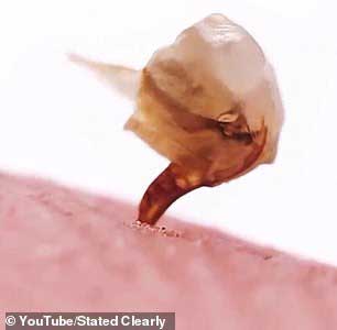 وقتی زنبور نیش می‌زند چه اتفاقی می افتد؟