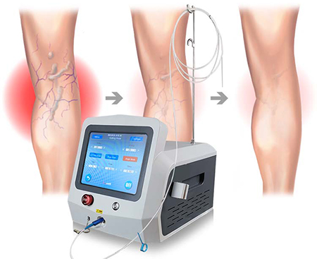 لیزر درون وریدی (EVLA)؛ راهی موثر برای درمان واریس