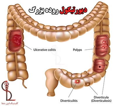 فرمول خوراکی در پاکسازی روده بزرگ